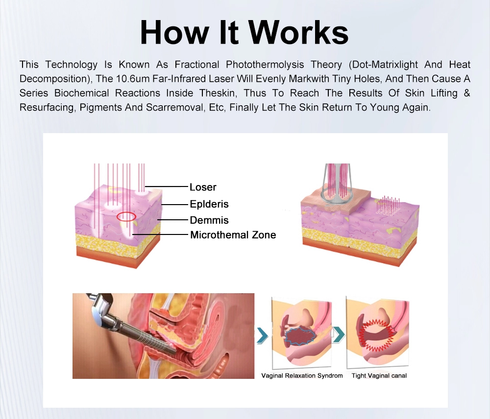Infographic explaining fractional photothermolysis laser treatment for skin rejuvenation and vaginal tightening. - HUIMAIN