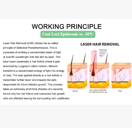 Diagram explaining the working principle of laser hair removal. - HUIMAIN