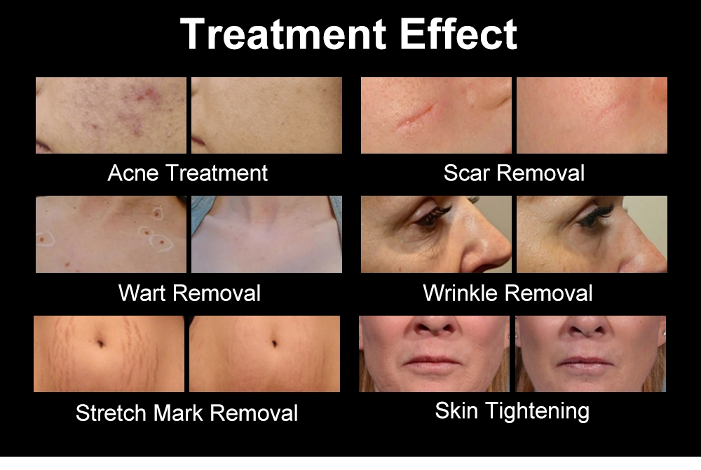 Before and after images showcasing the effects of various cosmetic treatments. - HUIMAIN