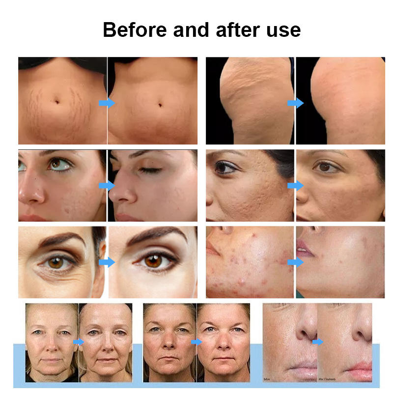 Before and after images showing improvements to skin conditions like stretch marks, cellulite, wrinkles, acne, and scars. Before and after images showing improvements to skin conditions like stretch marks, cellulite, wrinkles, acne, and scars.