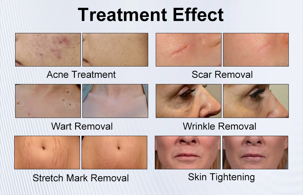 Before and after examples of cosmetic treatments including acne treatment, scar removal, wart removal, wrinkle removal, stretch mark removal, and skin tightening. - HUIMAIN