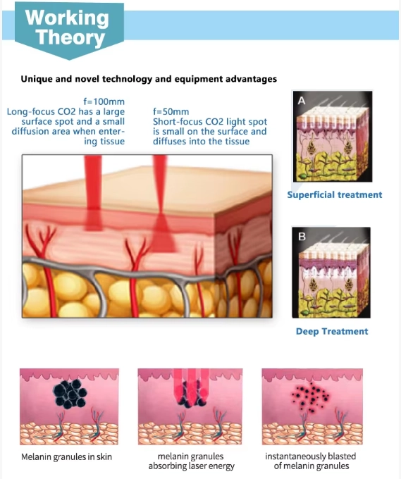 Diagram explaining the working theory of CO2 laser skin treatment. - HUIMAIN