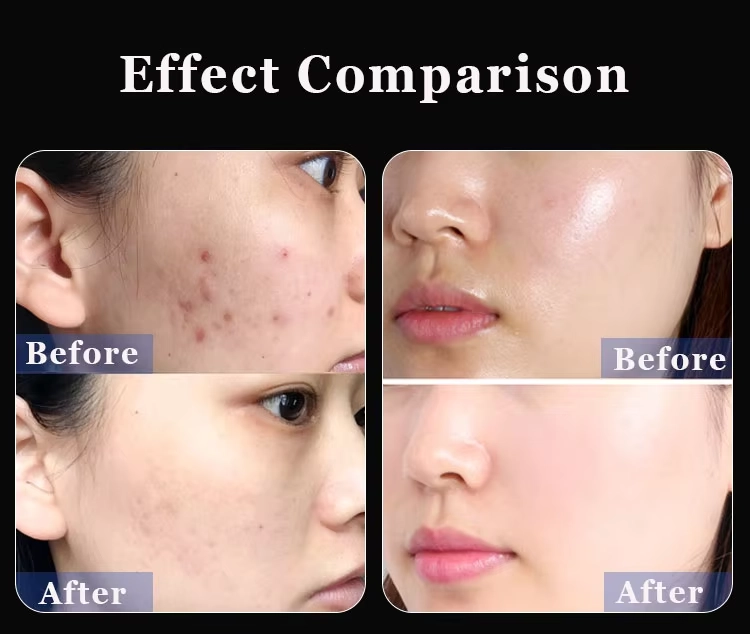 Before and after photos showing the improvement of acne and skin texture. - HUIMAIN