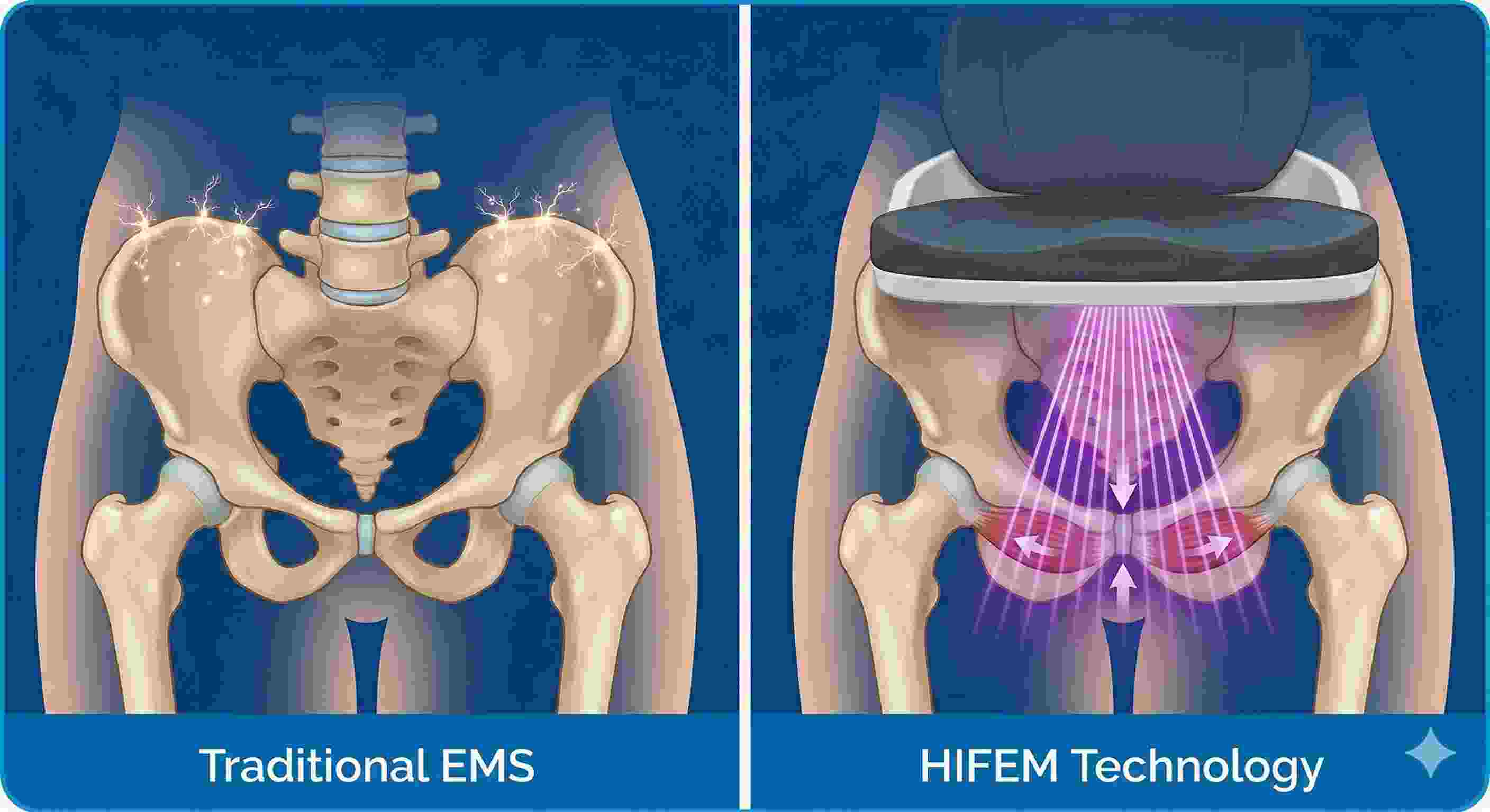 Comparison of traditional EMS vs. HIFEM technology for pelvic floor muscle stimulation, shown on a skeletal illustration of the pelvis. Comparison of traditional EMS vs. HIFEM technology for pelvic floor muscle stimulation, shown on a skeletal illustration of the pelvis.