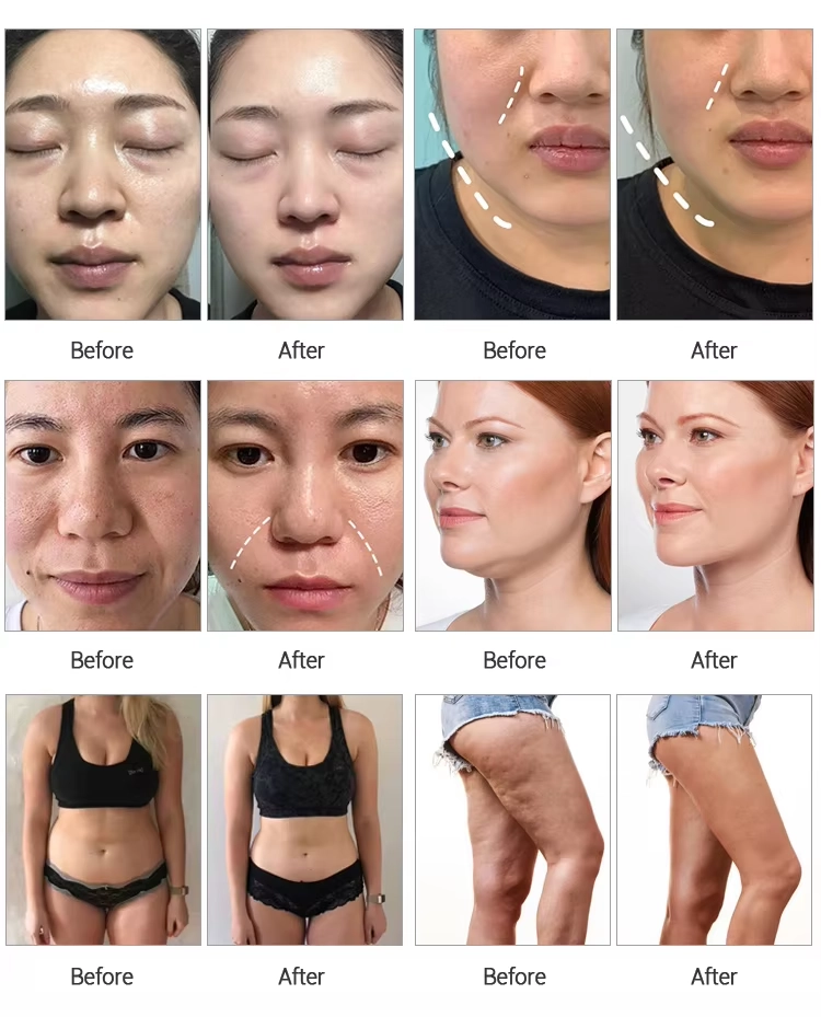 Before/After using the 10 in 1 cavitation vacuum machine. - HUIMAIN