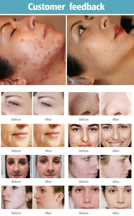 Customer feedback with before and after photos showing improved skin conditions. - HUIMAIN