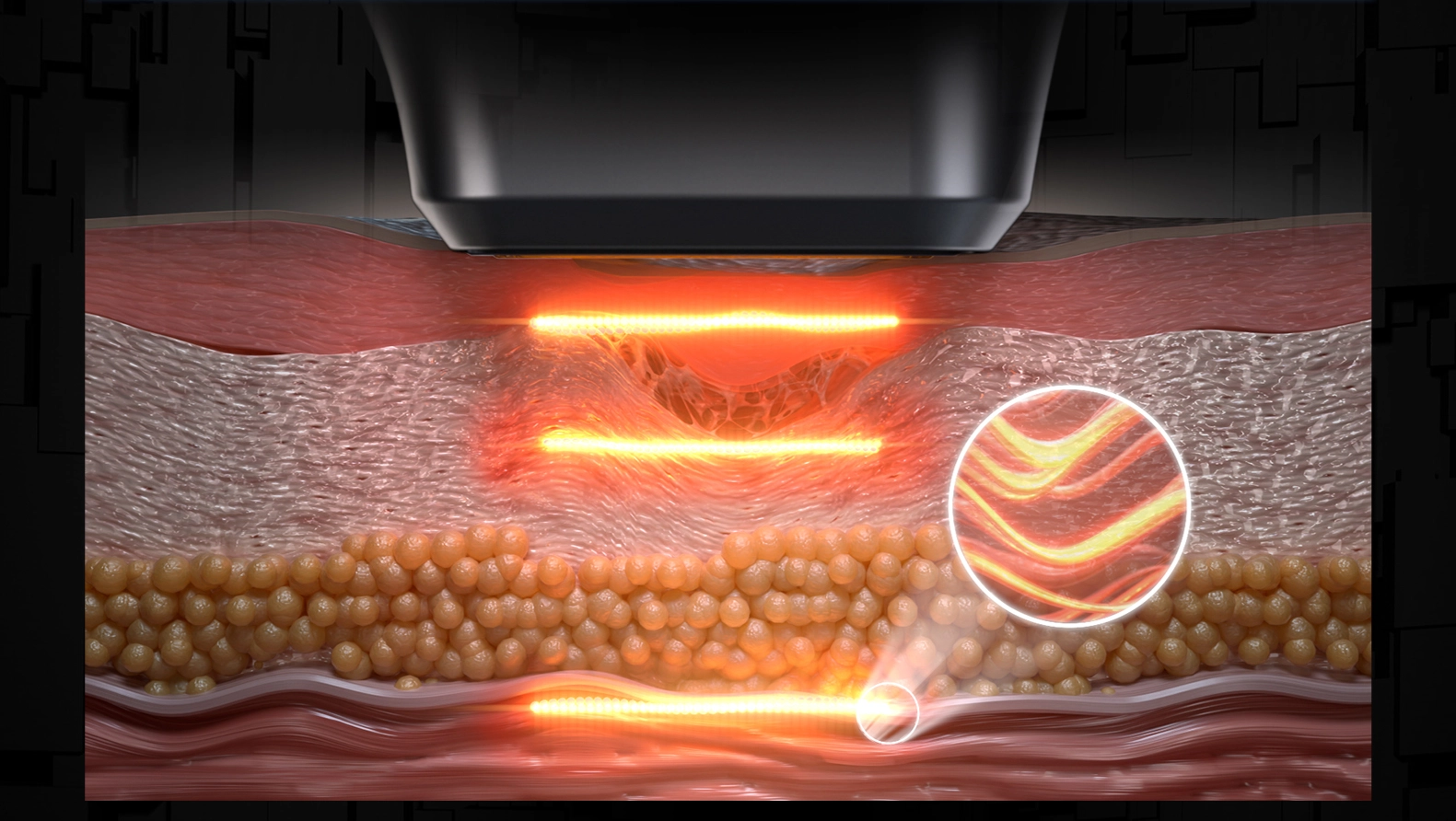 Diagram illustrating focused ultrasound waves penetrating skin layers, targeting collagen and fat. - HUIMAIN