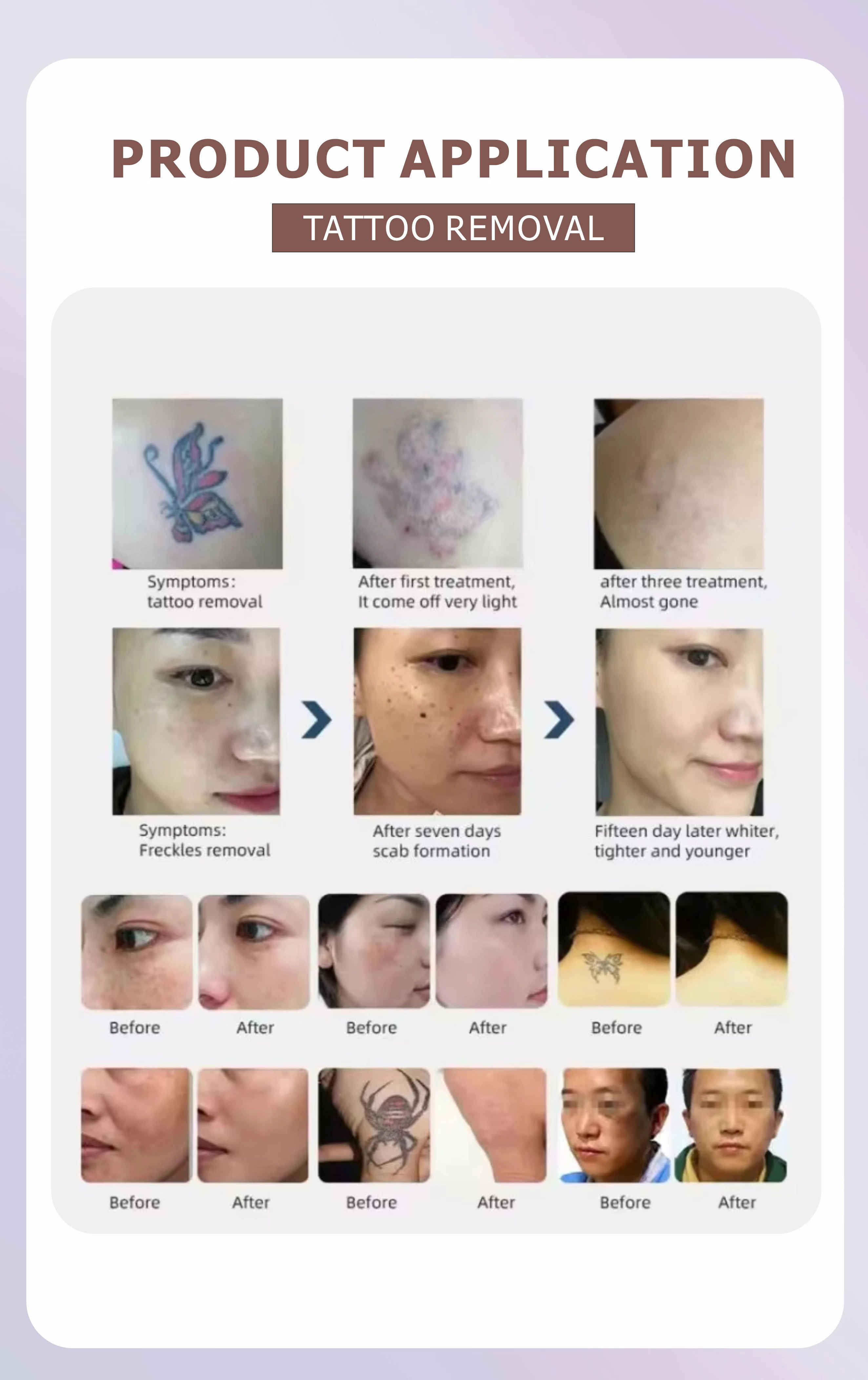 Aplicación del producto que demuestra la eficacia de los tratamientos de eliminación de tatuajes y pecas, con fotos de antes y después. - HUIMAIN