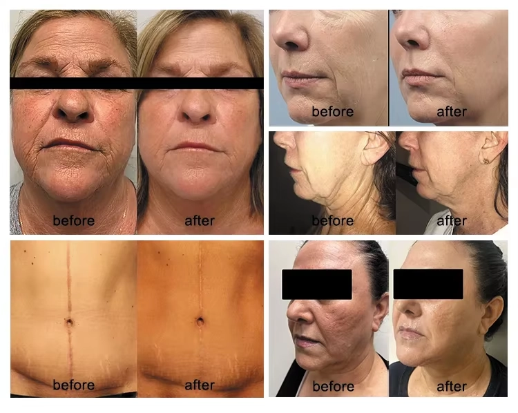 Before and after photos demonstrating various cosmetic surgery results, including facelifts and tummy tucks. - HUIMAIN