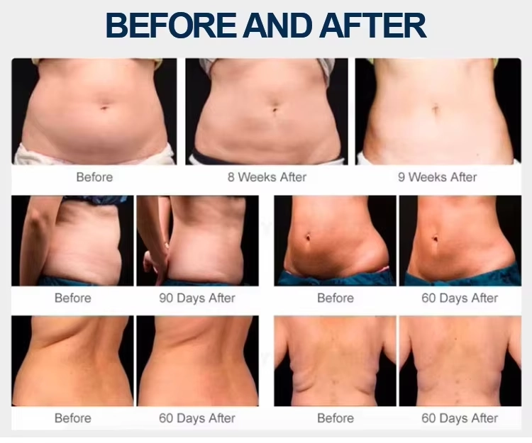 Before and after images showcasing body contouring results on the abdomen and back after weeks or months. - HUIMAIN