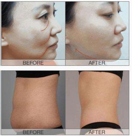 Before-and-after images showing the results of a cosmetic procedure on the face and torso. - HUIMAIN
