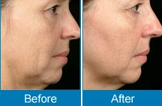 Woman's face in profile, showing before and after results of a cosmetic procedure to reduce wrinkles and sagging. - HUIMAIN