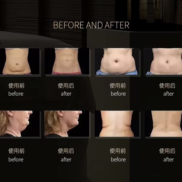 Before and after images showcasing body contouring results on the abdomen and neck.