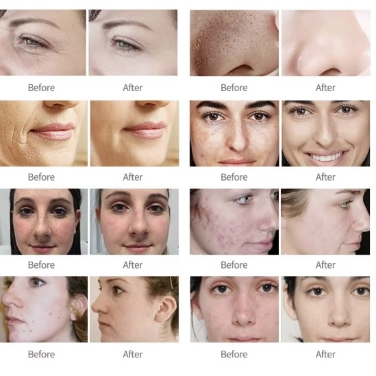 Before and after images showing skin improvements for wrinkles, pores, freckles, redness, acne, and blemishes. - HUIMAIN