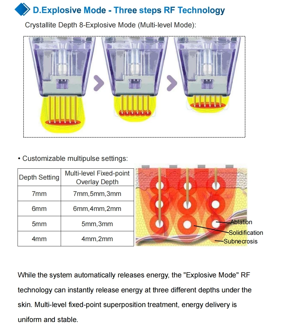 Diagram illustrating a three-step RF technology and its multi-level fixed-point overlay depth settings. - HUIMAIN