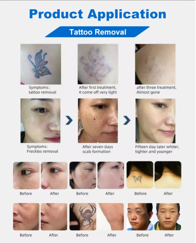Before-and-after images showcasing tattoo and freckle removal product application. - HUIMAIN