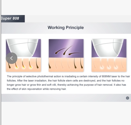 Diagram illustrating the Super 808 laser hair removal working principle. - HUIMAIN
