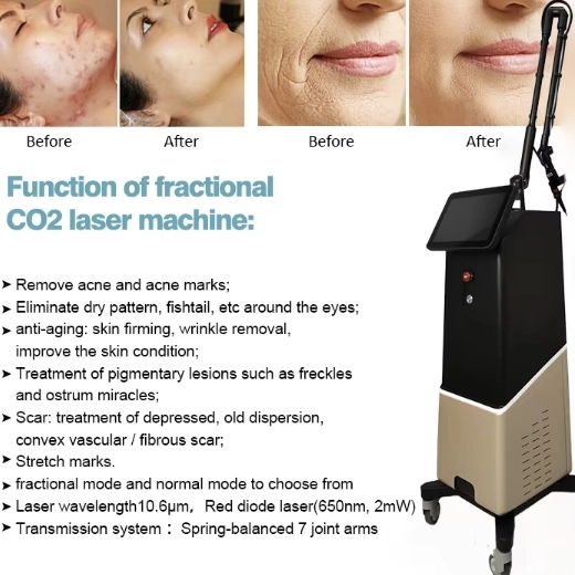 Fractional CO2 laser machine for skin rejuvenation, showing before and after results for acne and wrinkles. - HUIMAIN