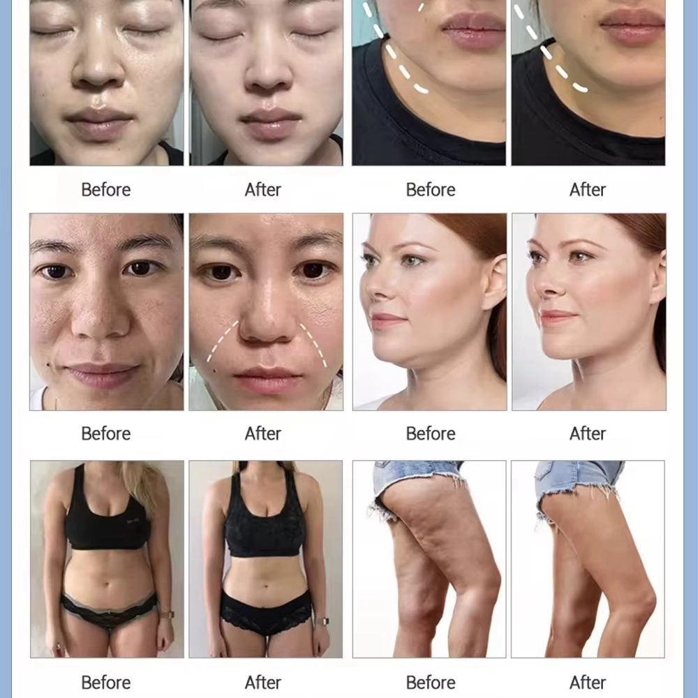 Results  Before & after using 6-in-1 cavitation vacuum machine. - HUIMAIN