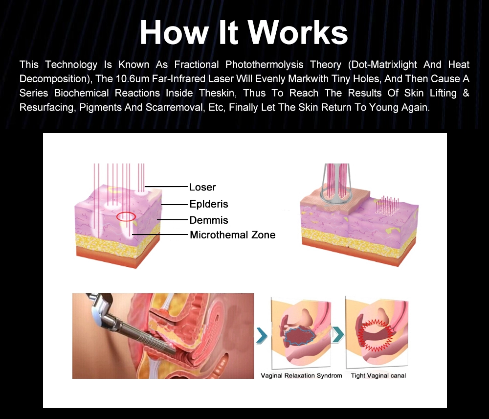 Diagram explaining fractional photothermolysis and vaginal rejuvenation. - HUIMAIN