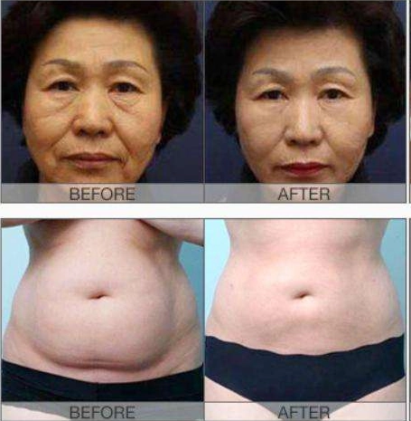 Before-and-after photos showing the results of a facelift and tummy tuck. - HUIMAIN