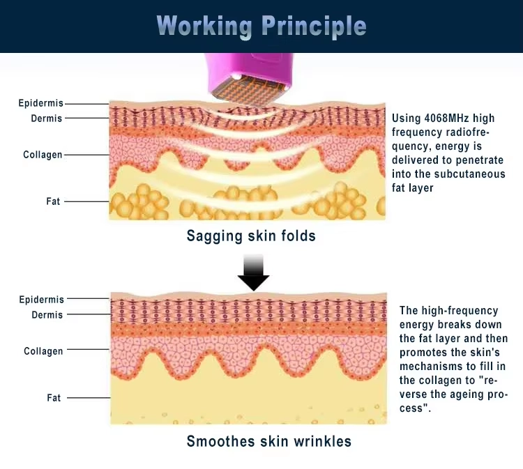 Diagram illustrating the working principle of a radiofrequency skin tightening treatment, showing how it penetrates the skin layers and reduces sagging. - HUIMAIN