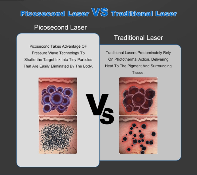 Picosecond Laser vs Traditional Laser Tattoo Removal: Visual Comparison of Ink Particle Breakdown. - HUIMAIN