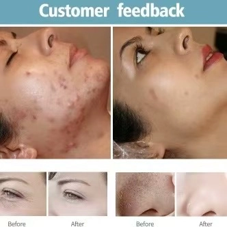 Customer feedback showing before-and-after images of skin treatment results; reduced acne and wrinkles. - HUIMAIN