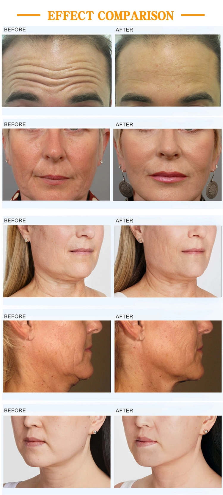 Before-and-after photos showcasing facial rejuvenation results, targeting wrinkles, skin laxity, and neck contouring. - HUIMAIN
