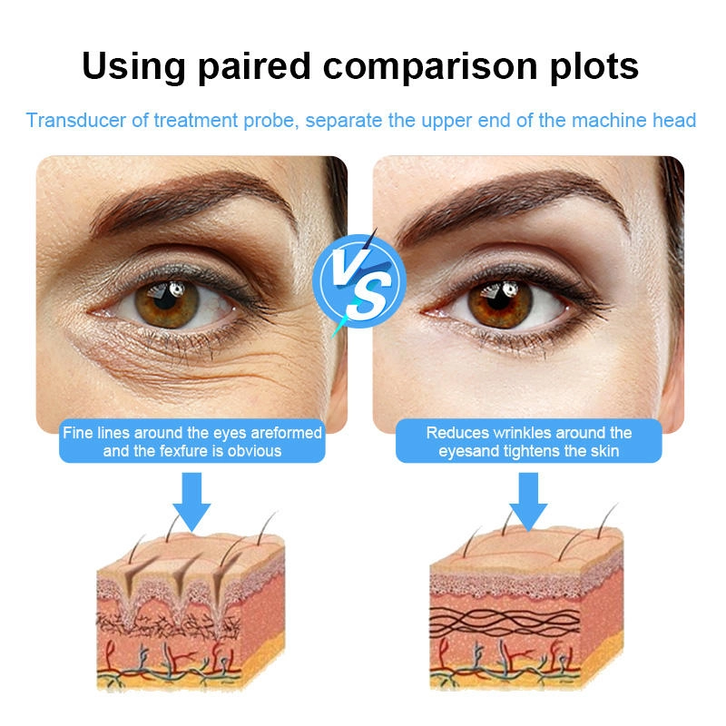 Before and after comparison of eye wrinkle reduction treatment, showing skin structure changes. - HUIMAIN