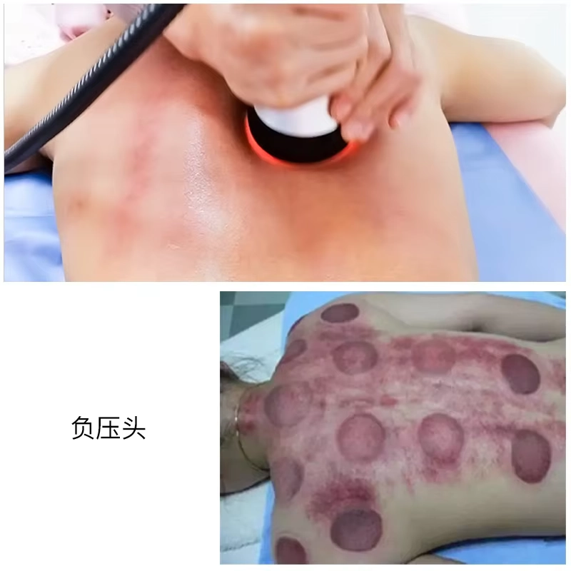 Image showing a person receiving cupping therapy, with a vacuum device and marks from cupping on their back. - HUIMAIN