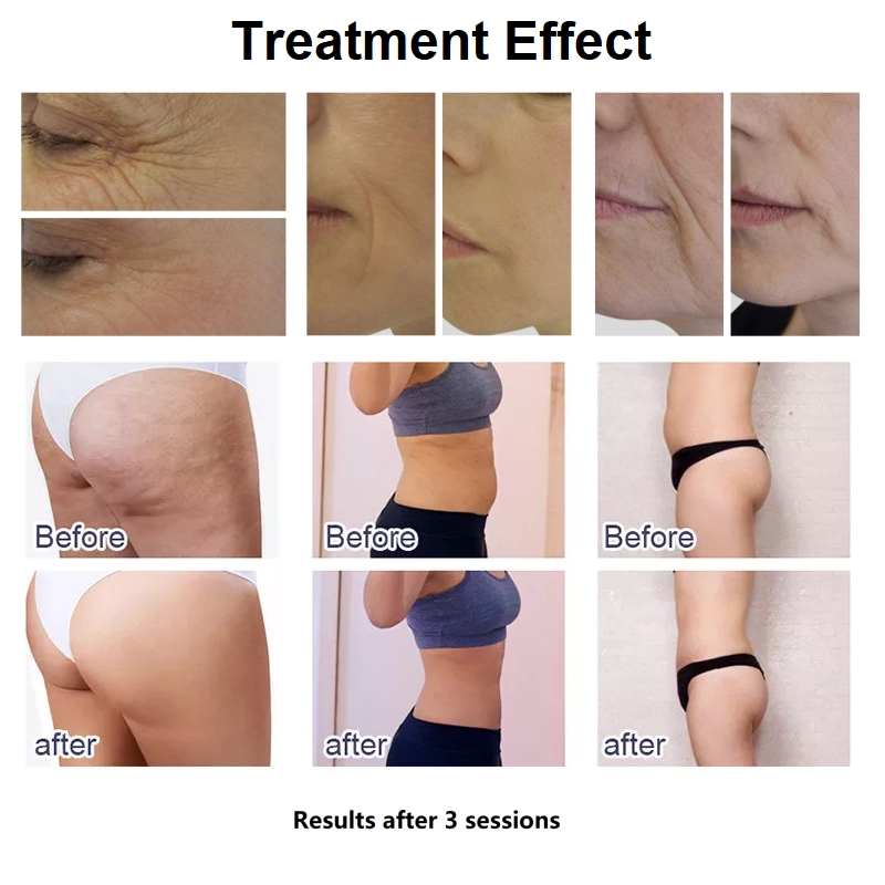 Before and After Photos Demonstrating Treatment Effects on Wrinkles, Cellulite, and Body Contouring After Three Sessions. - HUIMAIN