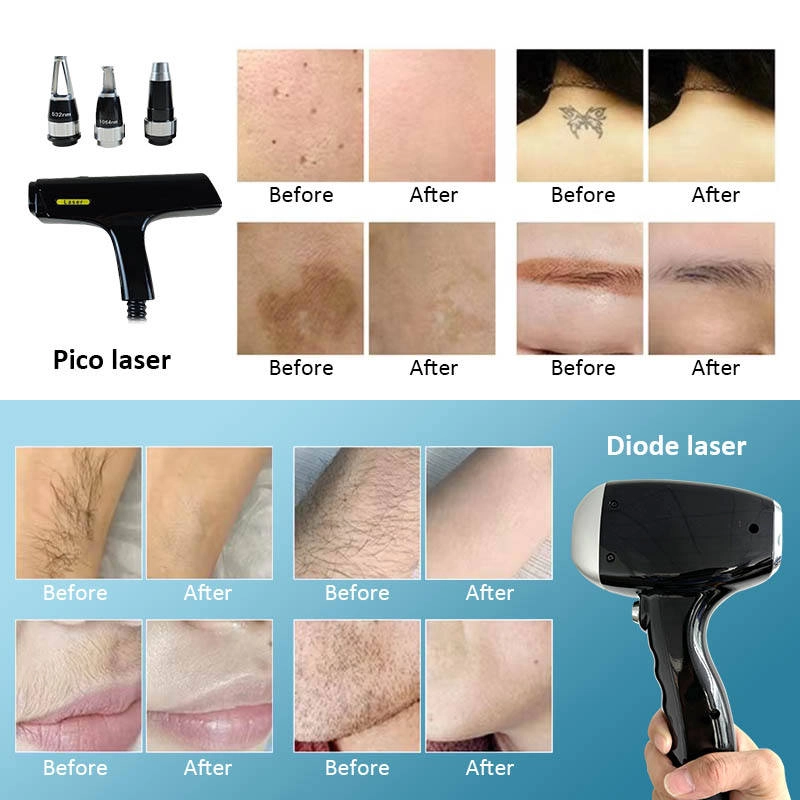 Pico and diode lasers for tattoo removal, skin pigmentation treatment, and hair removal, with before-and-after results. - HUIMAIN